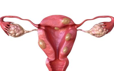 Ινομυώματα